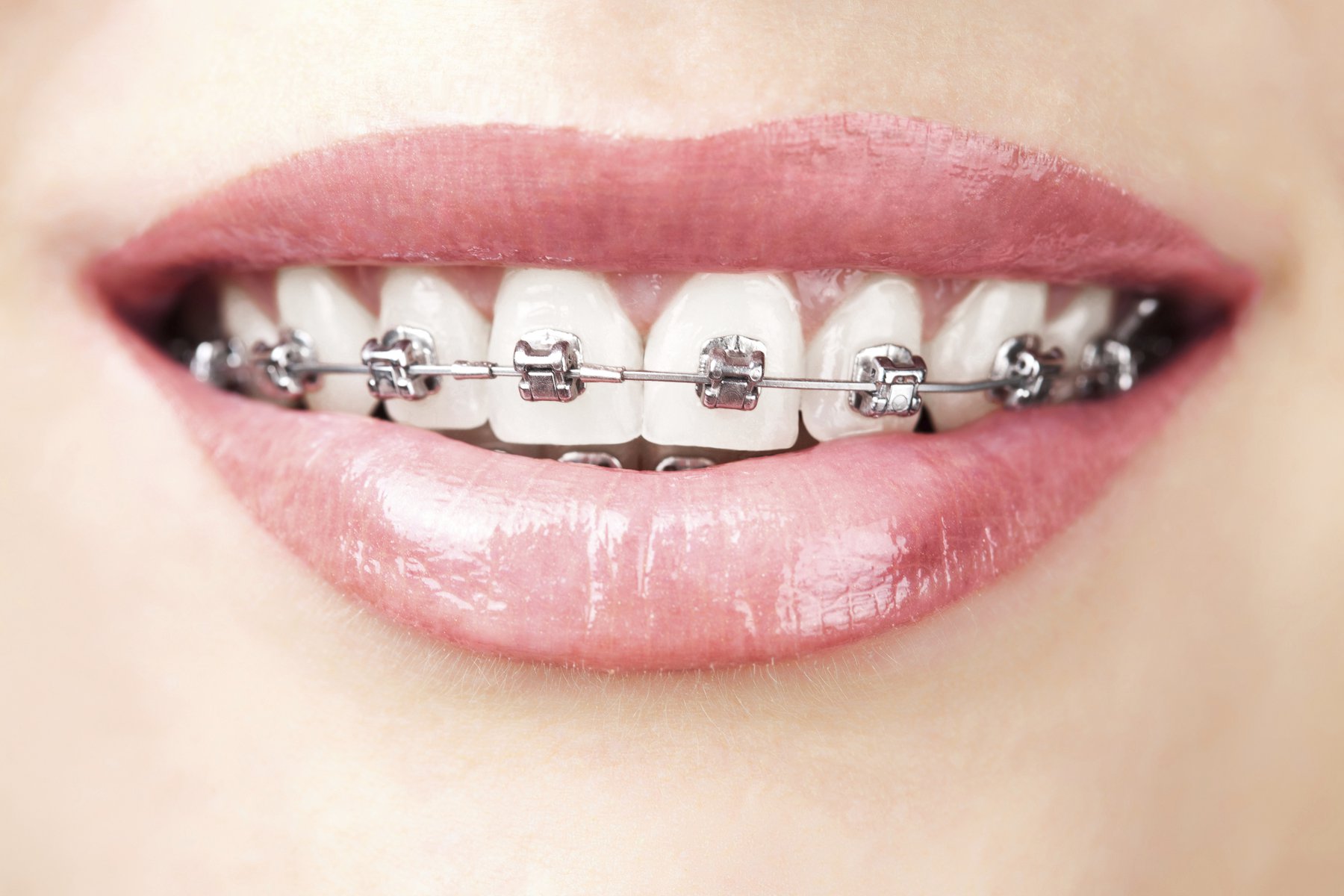 Cách chăm sóc răng miệng trong quá trình niềng răng đúng cách?