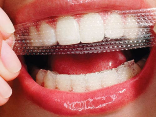 Bạn nên chọn phương pháp làm trắng răng nào?
